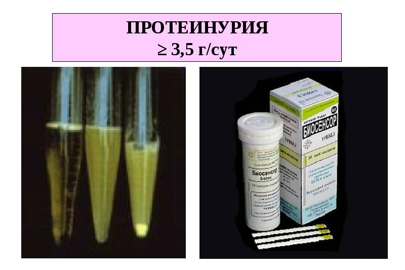 Протеинурия это. Протеинурия. Протеинурия у животных. Протеинурия картинки.