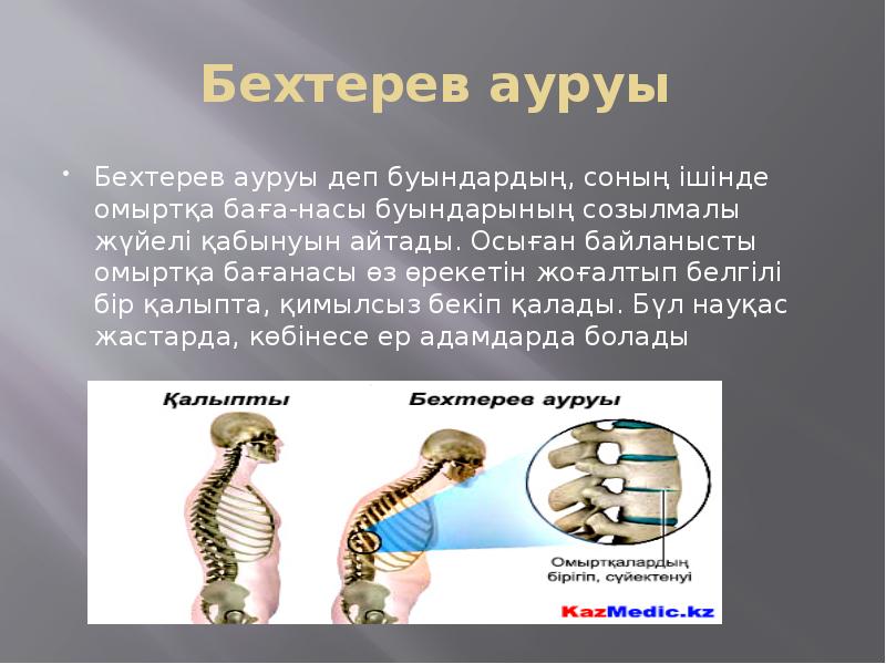 Бехтерев ауруы  Бехтерев ауруы деп буындардың, соның ішінде омыртқа баға-насы