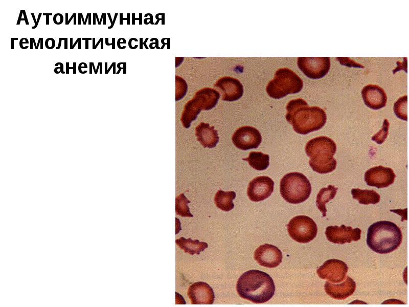 Гемолитическая анемия картина крови