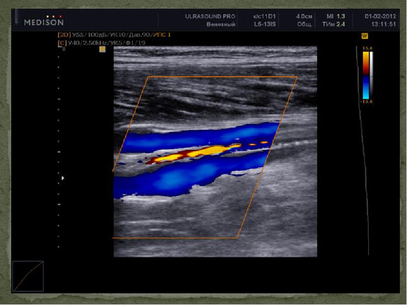 Сканирование вены. Ультразвуковое ангиосканирование дуплексное сканирование. Ультразвуковое дуплексное ангиосканирование вен нижних конечностей. Ультразвуковое дуплексное сканирование (УЗДС). Цветовое дуплексное сканирование артерий нижних конечностей.