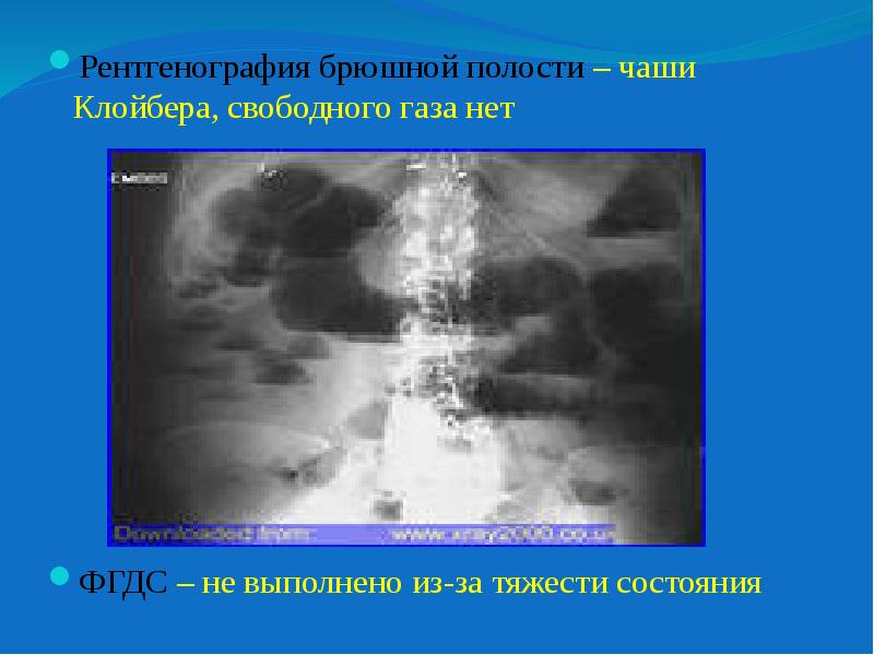 Свободный газ. Рентгенография брюшной полости чаши Клойбера. Рентген брюшной полости чаши Клойбера. Обзорная рентгенография брюшной полости Свободный ГАЗ. Чаши Клойбера на рентгенограмме.