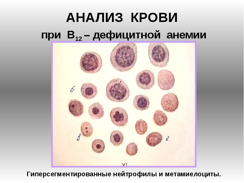 3 дефицитные анемии. Б12 дефицитная анемия. В12-пернициозная анемия. Анализ крови при анемии в12 дефицитной анемии. Анализ крови при в12 дефицитной.