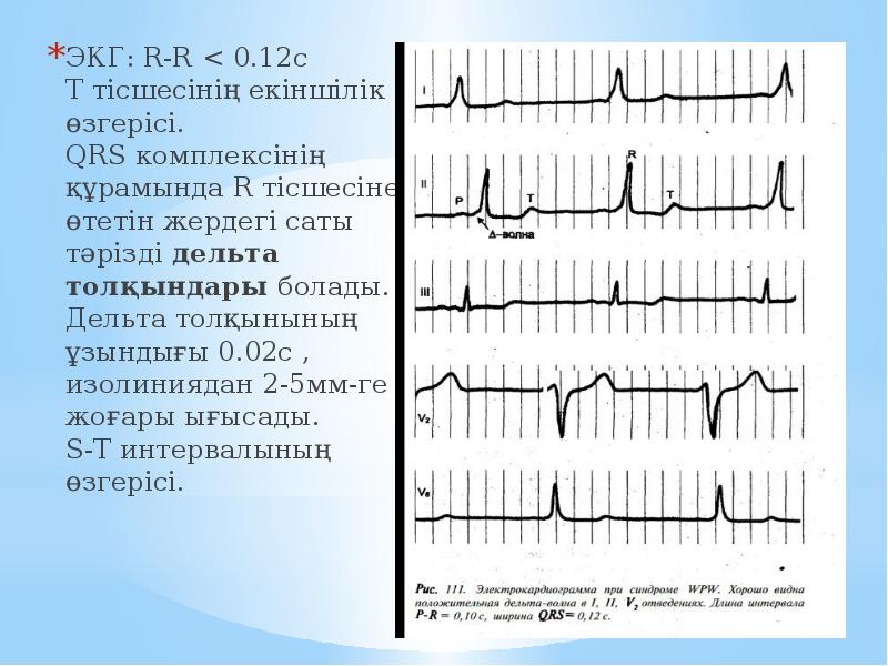 Высокий r на экг