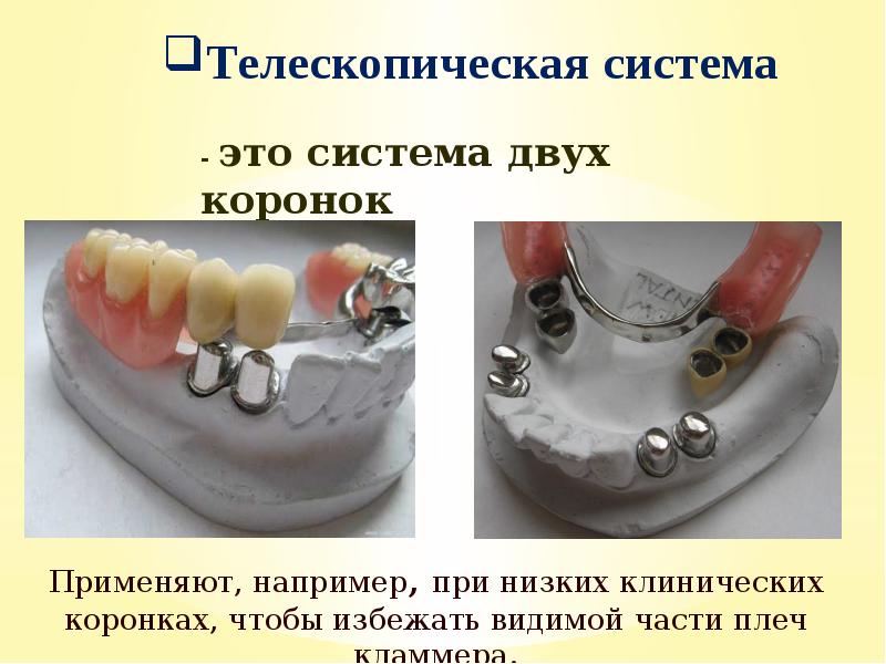 Бюгельное протезирование презентация