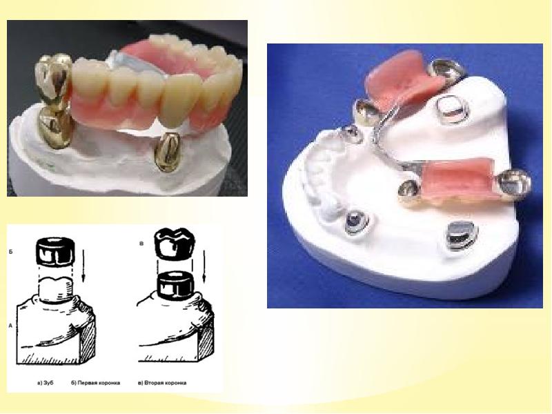 Методы фиксации и стабилизации съемных пластиночных протезов презентация