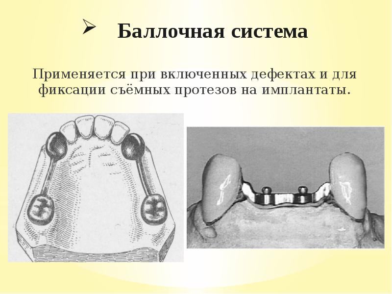 Методы фиксации и стабилизации съемных протезов при полном отсутствии зубов презентация