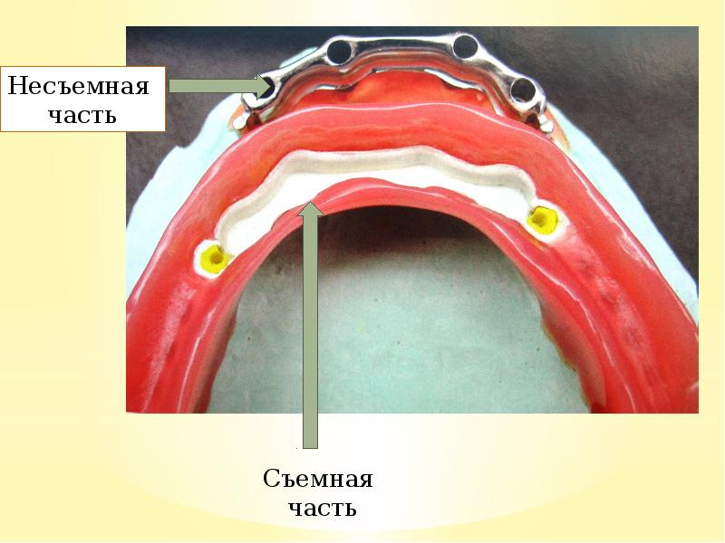Методы фиксации и стабилизации съемных протезов при полном отсутствии зубов презентация