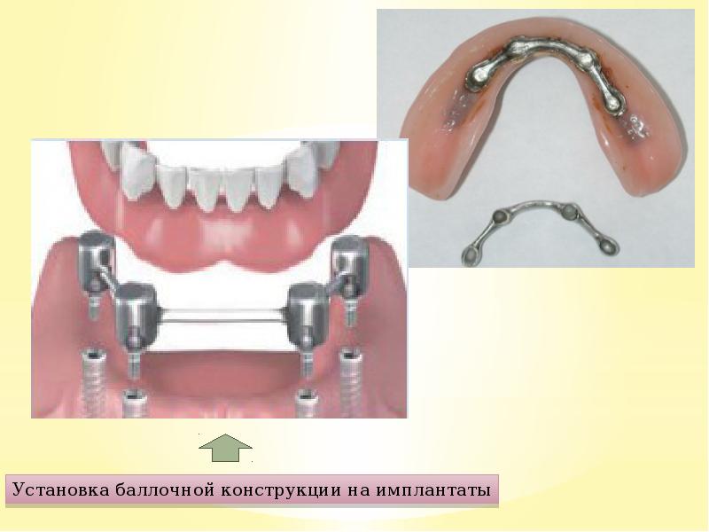 Бюгельные протезы презентация