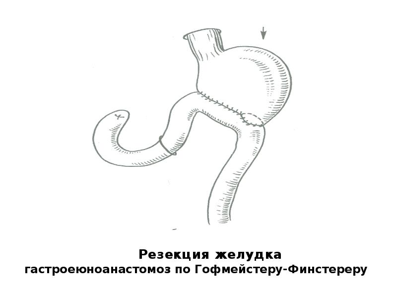 Гастрэктомия по сигалу схема