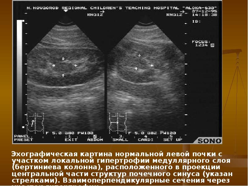 Эхографическая картина почек