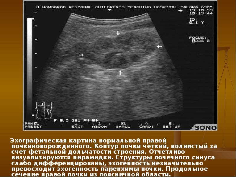 Эхографическая картина нестабильности в сегменте с2 с3