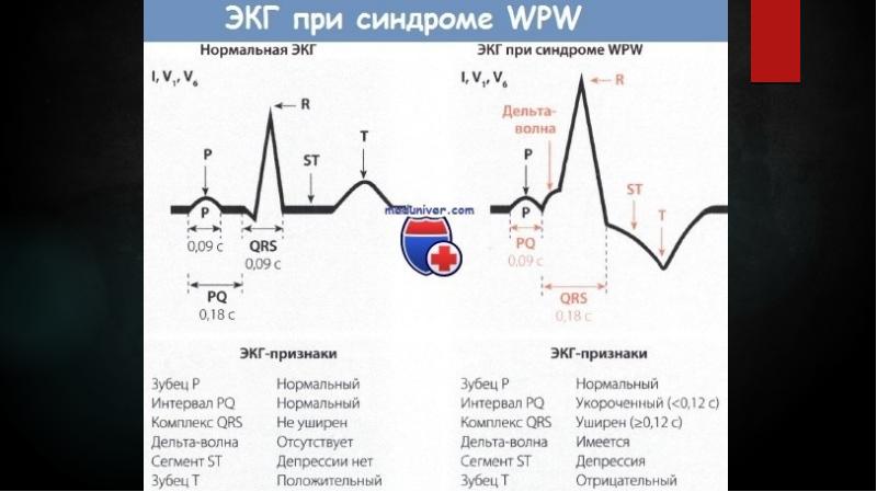 Феномен укороченного pq. Синдром wpw Тип а на ЭКГ. Дельта волна при ВПВ синдроме на ЭКГ. ЭКГ при синдроме Вольфа Паркинсона Уайта. Феномен Вольфа-Паркинсона-Уайта на ЭКГ.