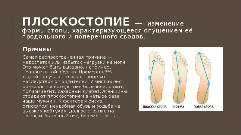 Опущение сводов стопы. Изменение формы стопы характеризующееся опущением её сводов. Опущение поперечного свода стопы. Плоскостопие поперечного свода стопы. Плоскостопие это изменение формы стопы характеризующееся.