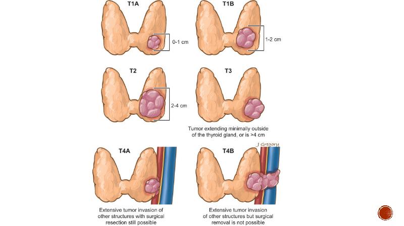 Аутоиммунный тиреоидит мкб. Аутоиммунный тиреоидит мкб 10. Дифференцированный рак щитовидной железы тест нмо. Методы обследования при заболевании щитовидной железы. Классификация новообразований щитовидной железы.