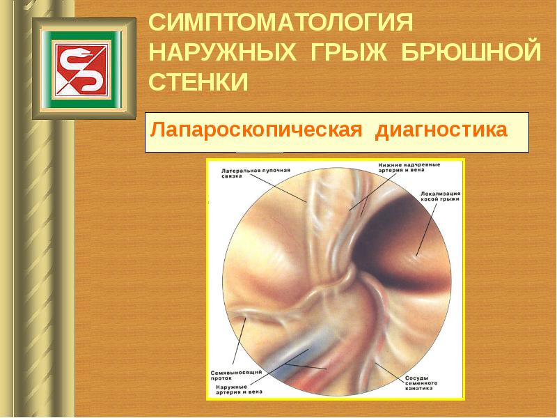 Современные методы лечения грыж передней брюшной стенки презентация