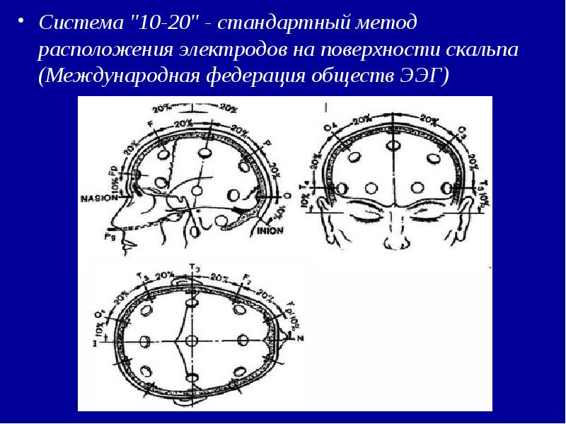 Схема 10 20 наложение электродов