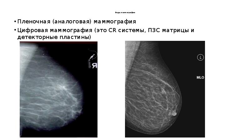 Матричный рисунок высокой плотности тип 3 молочной железы