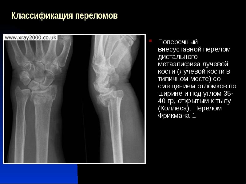 Образец описания рентгенограммы перелома