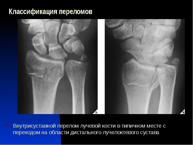 Перелом лучевой кости в типичном месте карта вызова смп