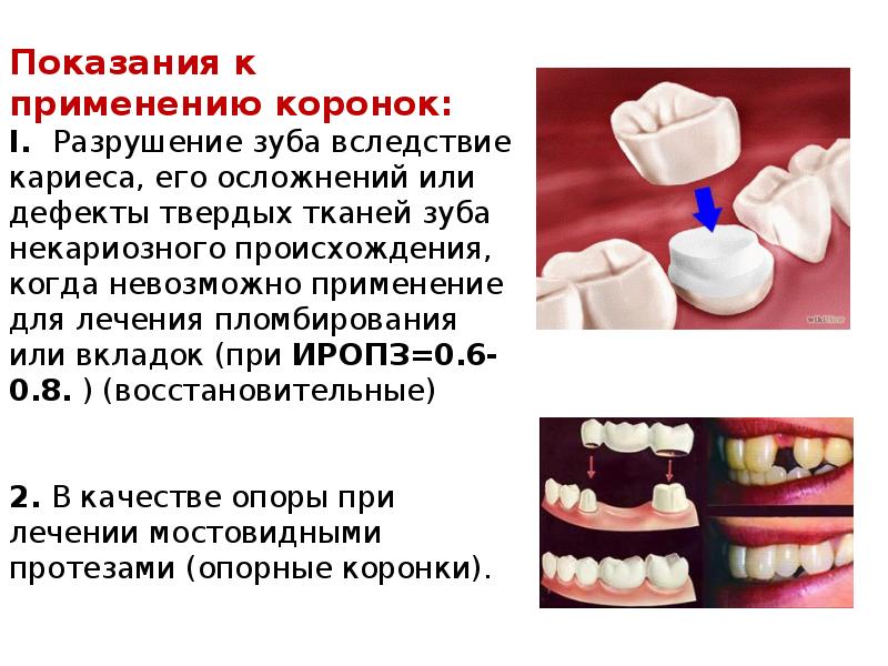 Способы индивидуализации несъемных реставраций зубов презентация