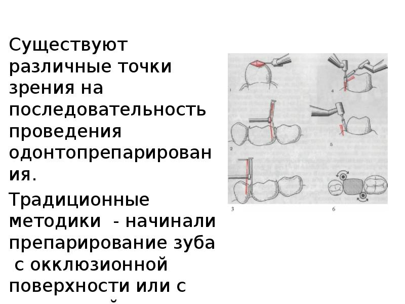 Штампованная коронка препарирование