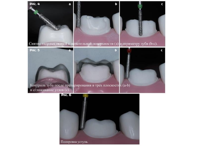 Препарирование под коронки презентация