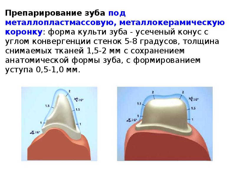 Препарирование под металлическую коронку схема