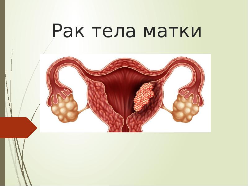 Рак Матки Секс Рак Матки Секс