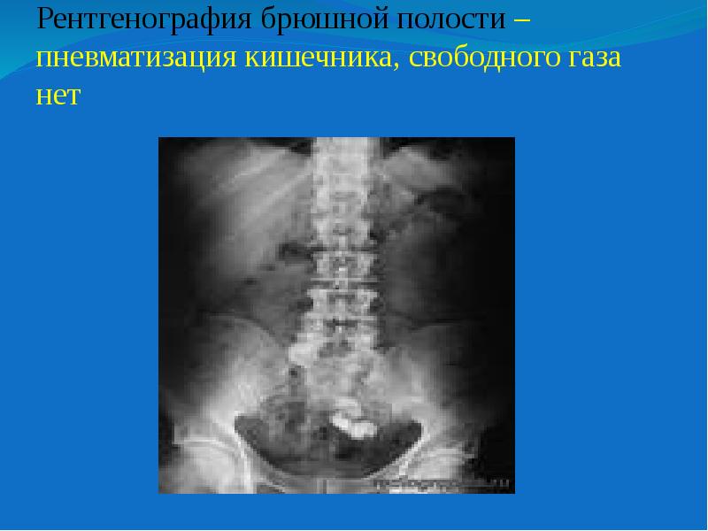 Симптомы пневматоза кишечника лечение. Пневматоз толстой кишки рентген. Пневматоз петель Толстого кишечника. Свободный ГАЗ В брюшной полости рентген. Пневматизация толстой кишки что такое.