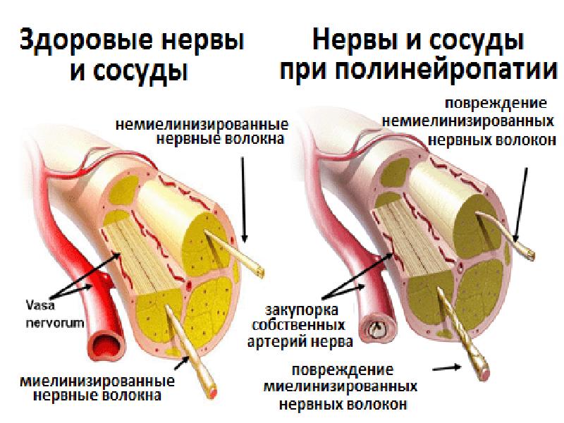 Сосуды при диабете. Осложнения сахарного диабета диабетическая нейропатия. Диабетическая нейропатия нерв. Диабетическая сенсорная полинейропатия. Диабетическая периферическая нейропатия.