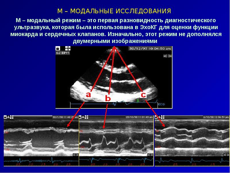 Эхокардиография сердца презентация