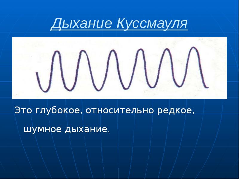 Дыхание Куссмауля Это глубокое, относительно редкое, шумное дыхание.