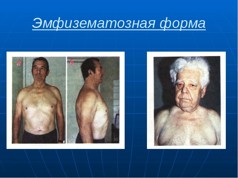 Эмфизематозная форма