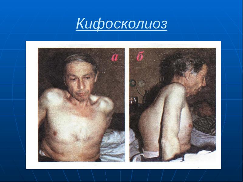 Кифосколиоз