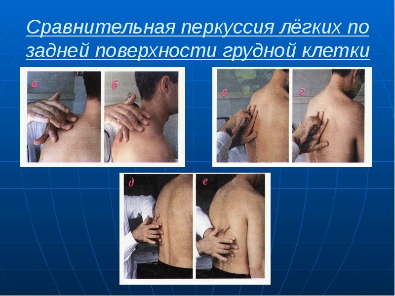 Сравнительная перкуссия лёгких по задней поверхности грудной клетки