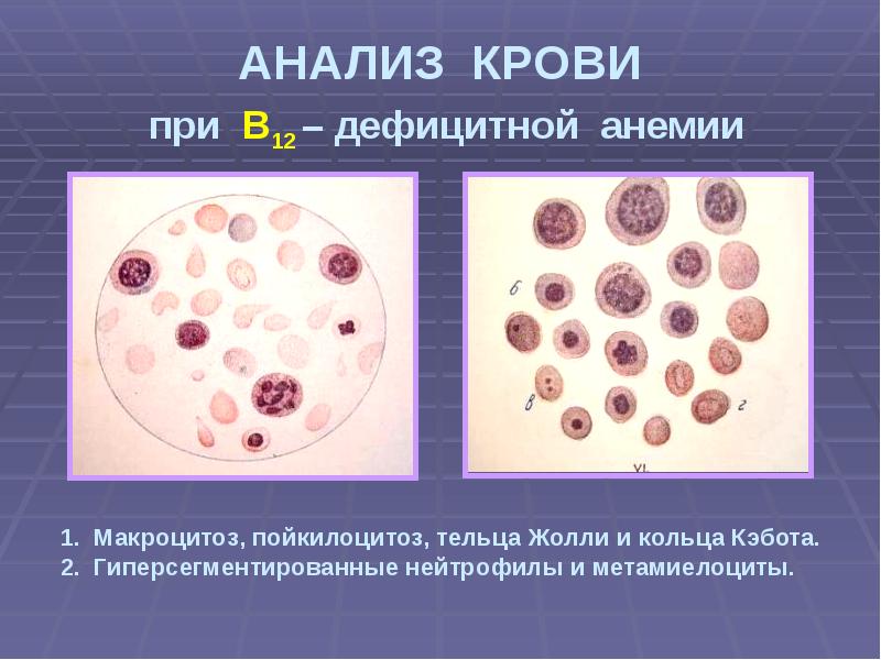 Анемия пропедевтика внутренних болезней презентация