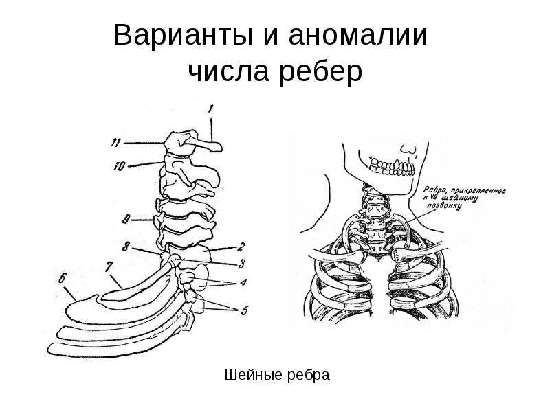 Скелет туловища тест. Аномалии количества ребер. Аномалии развития числа ребер. Аномалия строения ребер.