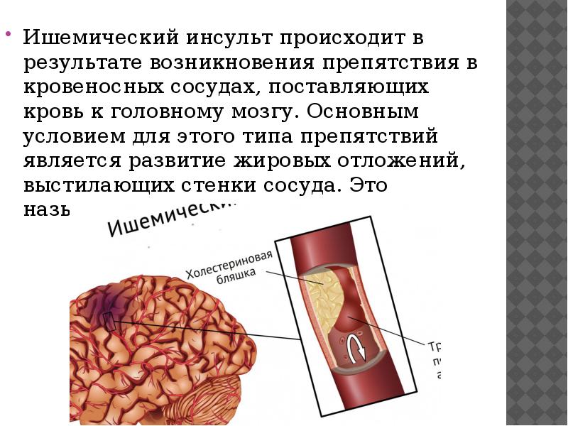 Последствия ишемического инсульта