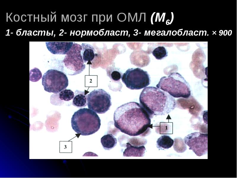 хронический лимфолейкоз бластные клетки. норма пластов в костном мозге. мегакариобластный лейкоз картина крови. костный мозг исследование пунктата костного. острый промиелоцитарный лейкоз м3.