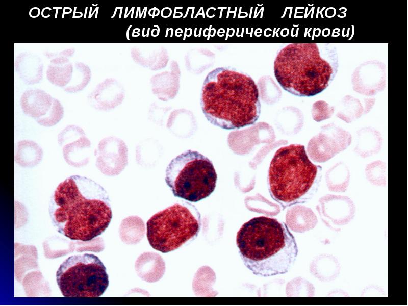 Лимфобластный лейкоз. Острый лейкоз периферическая кровь. Острый лимфобластный лейкоз кровь. Острый лимфобластный лейкоз картина периферической крови. Острый лимфолейкоз патофизиология.