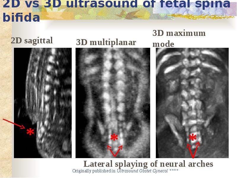 Spina bifida