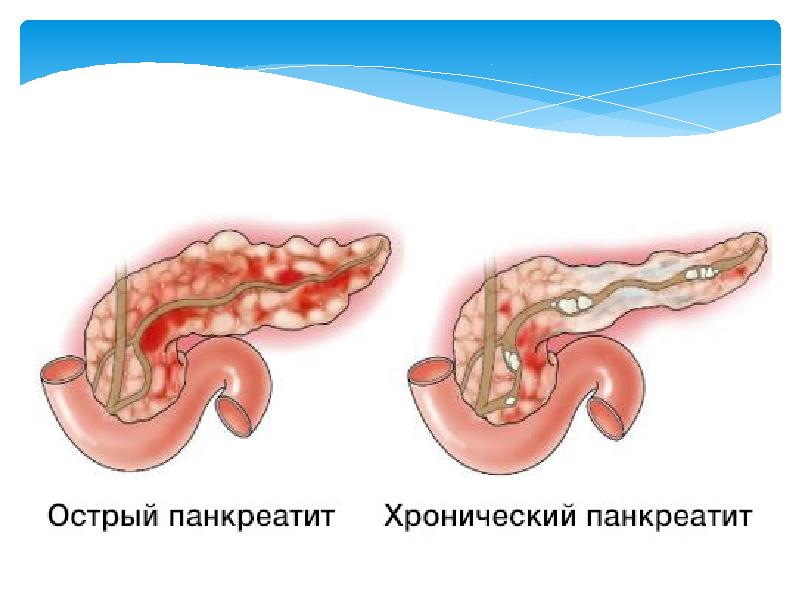 Хронический панкреатит. Поджелудочная железа при панкреатите. Патология острого панкреатита.