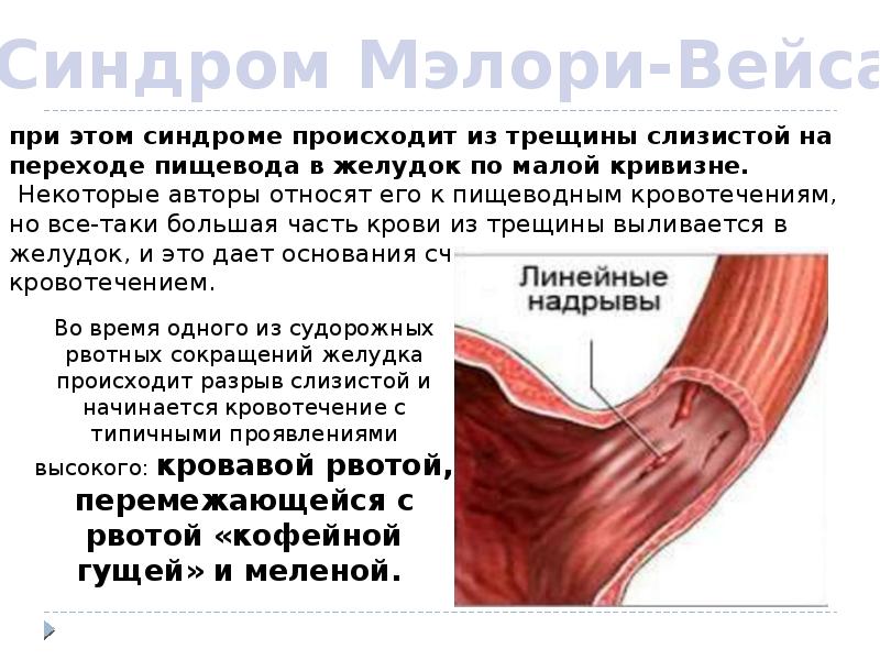 При этом это может. Пищеводное желудочное кишечное кровотечение. Причины желудочного кровотечения. Кровотечение в желудке симптомы. Внутреннее желудочное кровотечение.