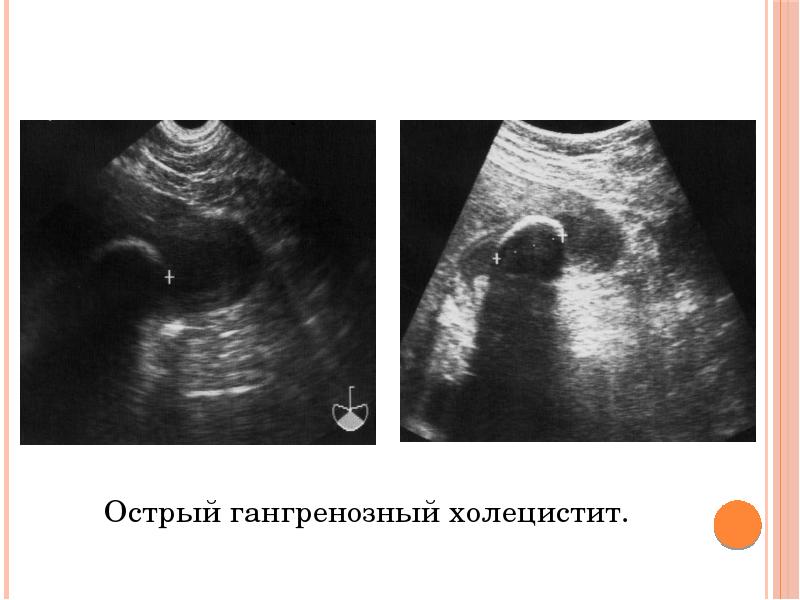 Холецистит на узи фото