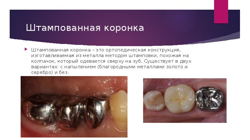 Штампованные коронки презентация