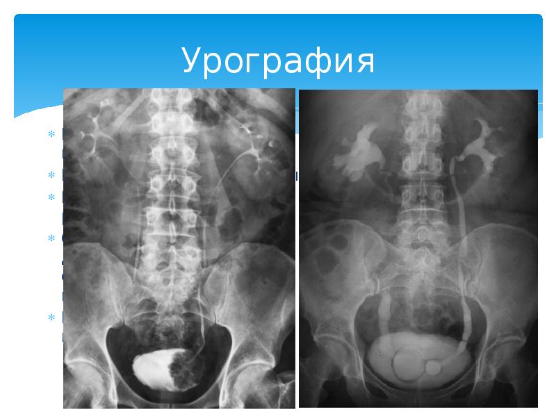 Методом позволяющим получить изображение мочевых путей без контрастирования является