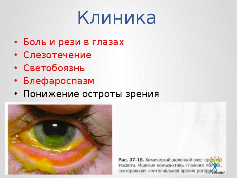 Презентация на тему ожог глаз