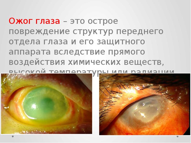 Презентация на тему ожог глаз