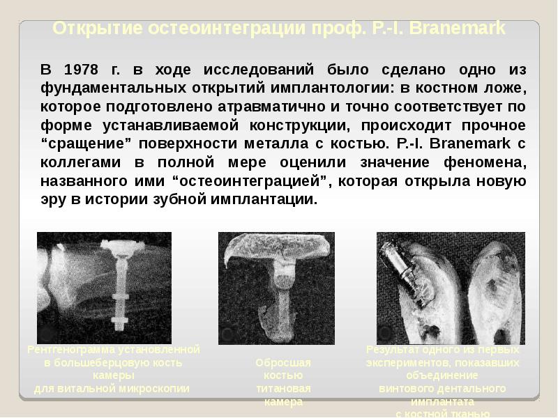 История имплантации зубов презентация