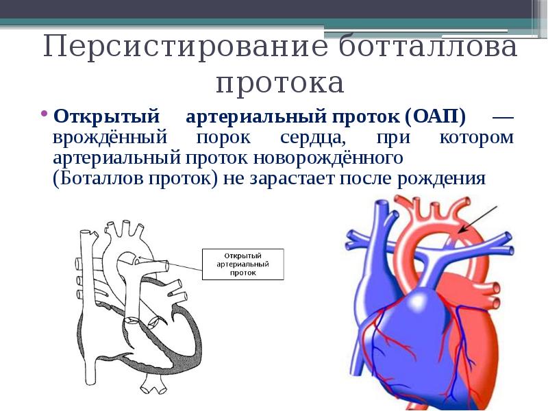 Функционирующий артериальный проток. ВПС: - открытый Баталов проток. Артериальный боталлов проток. Порок сердца боталлова протока.